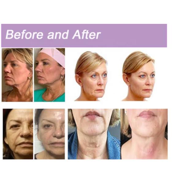 Purple Molding Cog PDO Threads W Needle Anchoring Type