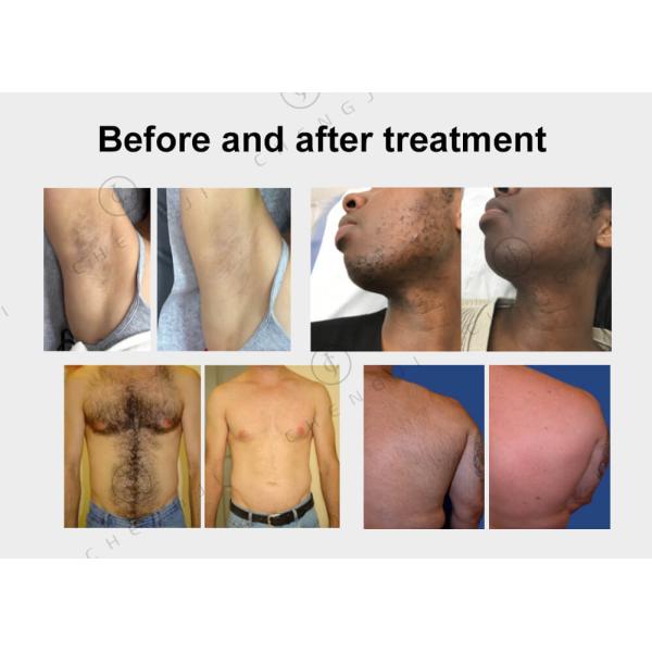 1200w Diode Laser Hair Removal Device Three Wave Laser Removal Machine 3 in 1