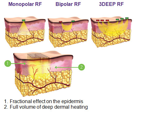Wrinkle Removal Skin Rejuvenation Microneedle RF Machine