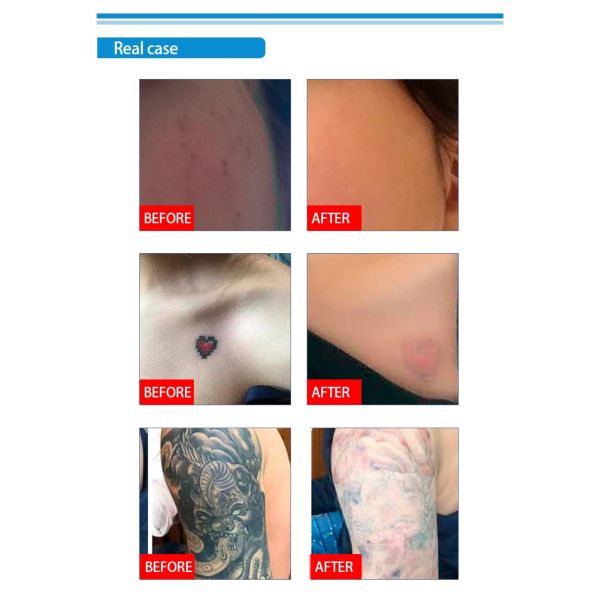 Nd Yag Pico Laser Tattoo Removal , Laser Resurfacing Machines 1064nm