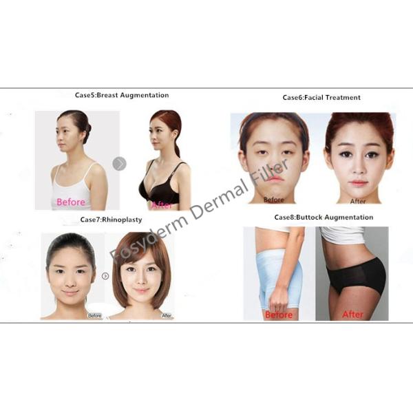 Fosyderm 1ml Cross Linked Dermal Filler Hyaluronic Acid For Nose Injection Safety