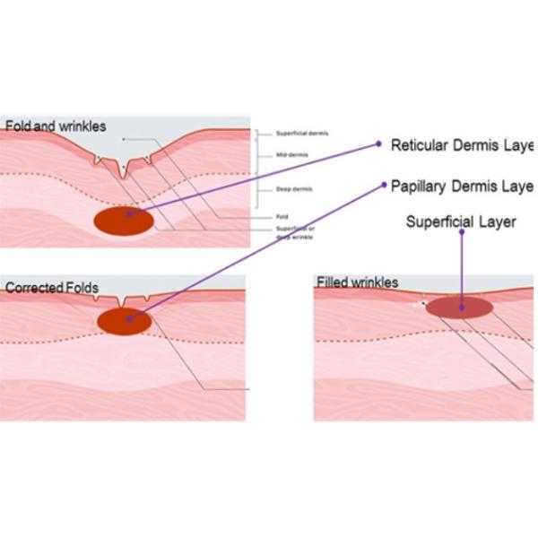 Nubway fractional rf microneedle face treatment machine