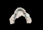 Tailored Cast Partial Denture with Personalized Aesthetics and Secure Fit for