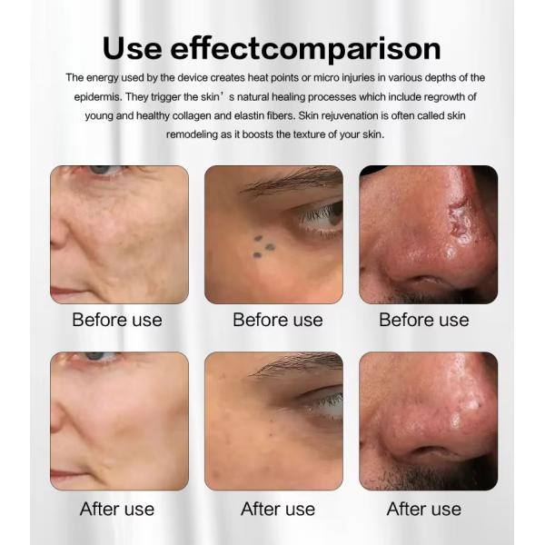 Portable 1060nm C02 Fractional Laser For Wrinkles Stretch Marks Removal Vaginal Tighten