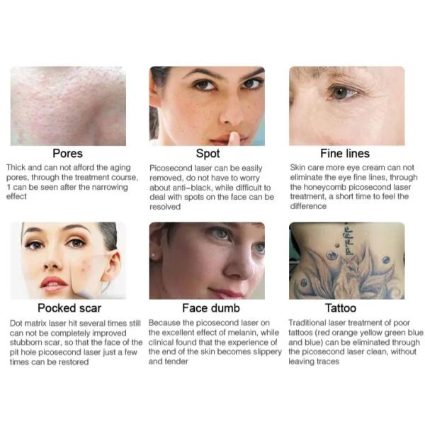 As60 Picosecond Q Switched Nd Yag Home Use Laser Tattoo Removal Shrinks Pores Pigmentation Removal