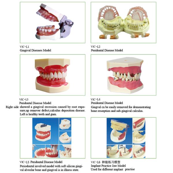 Peridontal Disease Teeth Study Model Human Dental Model Gingival Diseases