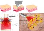 980nm diode laser vascular removal spider vein removal at home blood vessels