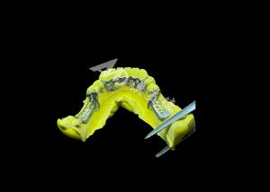 Tailored Cast Partial Denture with Personalized Aesthetics and Secure Fit for Enhanced Comfort and Functionality