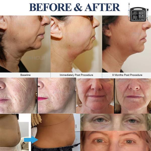 Face Lift Anti Aging 5D HIFU Beauty Machine 2 In 1 High Intensity Focused Ultrasound