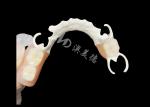 Custom Cast Partial Denture with HPP framework for Enhanced Chewing and Speech