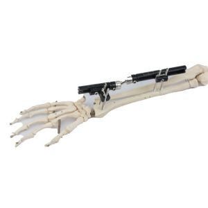 Quality Sterilized Bone Fracture Distal Radius External Fixator for sale