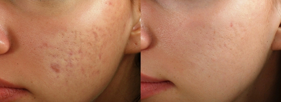 Sublative RF Machine Innovative Skin Resurfacing And Facial Countour Technology For All Skin Types