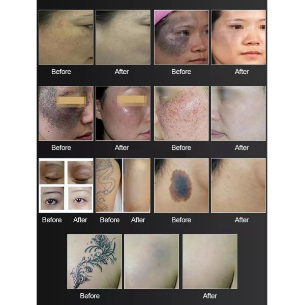 Picosecond Pico Laser Q Switched Nd Yag Laser 1064Nm 532Nm 1320Nm Skin Rejuvenation Skin Whitening Tattoo Removal Machine