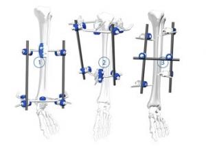 Flexible Orthopedic Trauma Implants Tibial Plateau Frame External Fixation