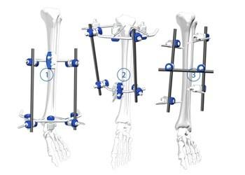 Buy Flexible Orthopedic Trauma Implants Tibial Plateau Frame External Fixation at wholesale prices