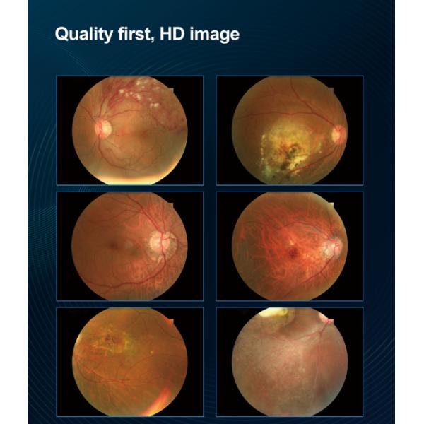 State-of-the-Art Non Mydriatic Fundus Camera with Dual Camera System for Eye Condition Assessment