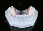 Natural Looking Valplast Partial Denture Longevity Highly Resistant To Fractures